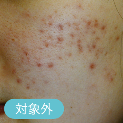 ニキビ跡の赤み